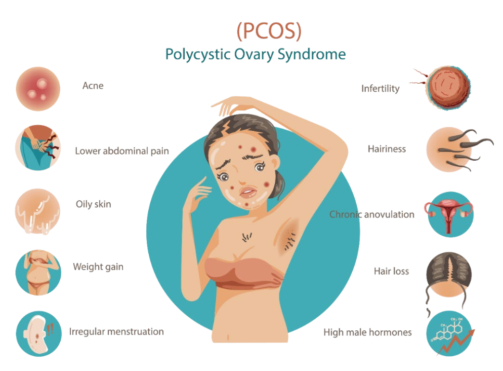 ภาพอธิบายอาการ PCOS เช่น ประจำเดือนผิดปกติ สิว ขนเพิ่ม และลักษณะอื่นที่อาจพบ